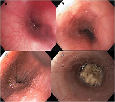 Endoscopy in Pediatric Eosinophilic Esophagitis